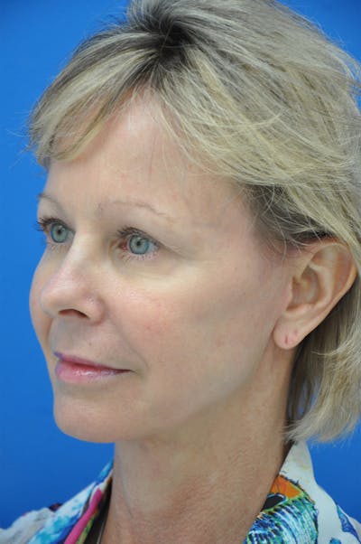 Facelift Before & After Gallery - Patient 116252810 - Image 2