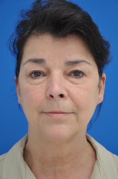 Facelift Before & After Gallery - Patient 116252813 - Image 1