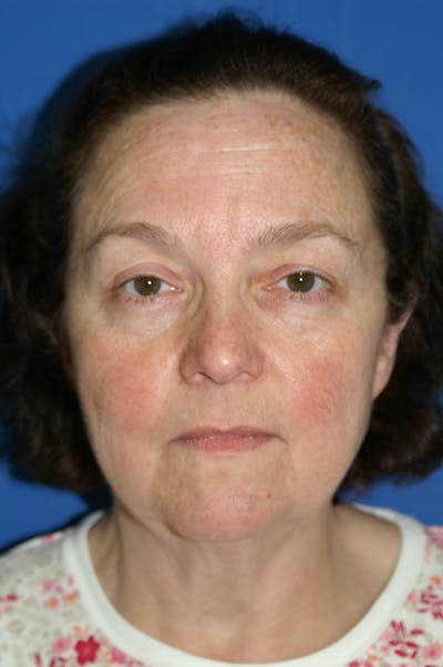 Facelift Before & After Gallery - Patient 116252836 - Image 1