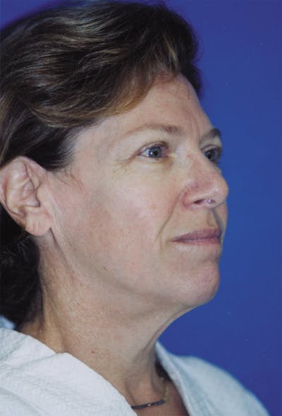 Facelift Before & After Gallery - Patient 116252868 - Image 1