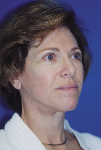 Facelift Before & After Gallery - Patient 116252868 - Image 2