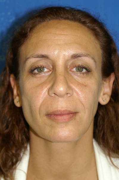Facelift Before & After Gallery - Patient 116252880 - Image 1