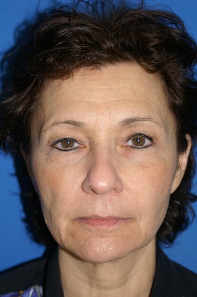 Facelift Before & After Gallery - Patient 116252882 - Image 1