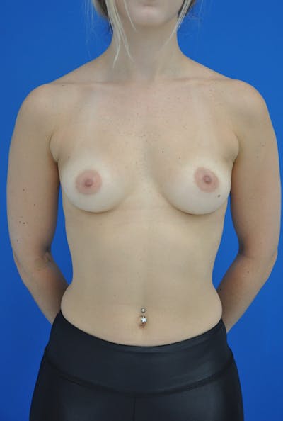 Breast Augmentation Before & After Gallery - Patient 146248238 - Image 1