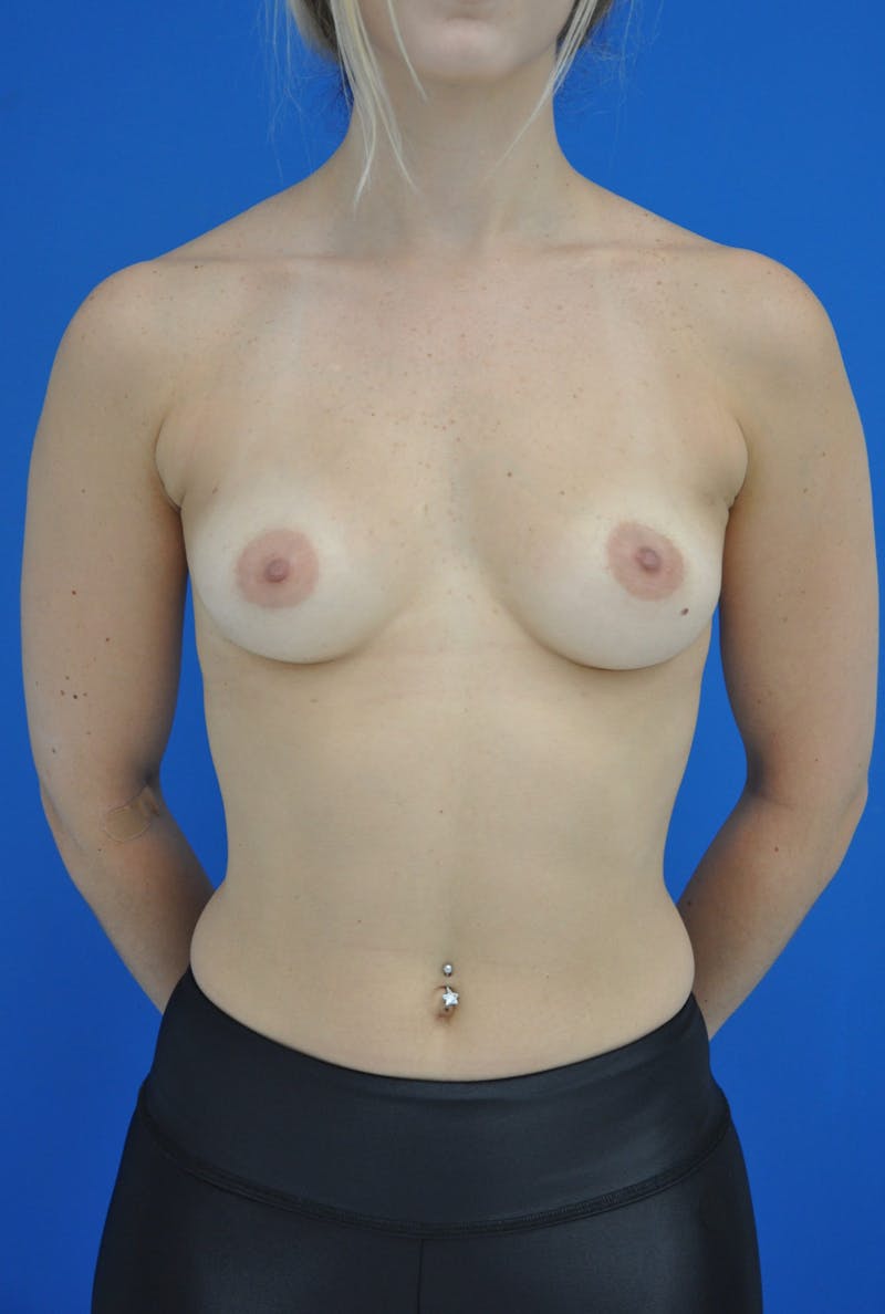 Breast Augmentation