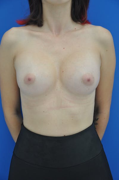 Breast Augmentation Before & After Gallery - Patient 146248245 - Image 2