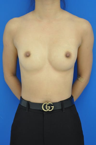 Breast Augmentation Before & After Gallery - Patient 146248246 - Image 1