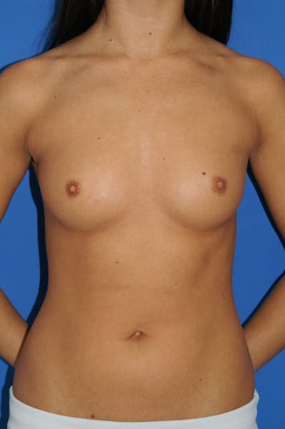 Breast Augmentation Before & After Gallery - Patient 146248251 - Image 1