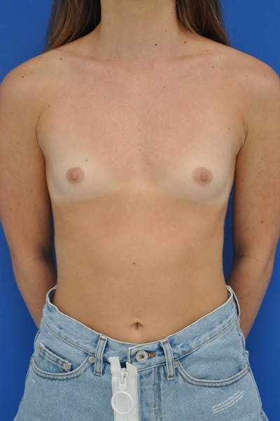 Breast Augmentation Before & After Gallery - Patient 146248616 - Image 1
