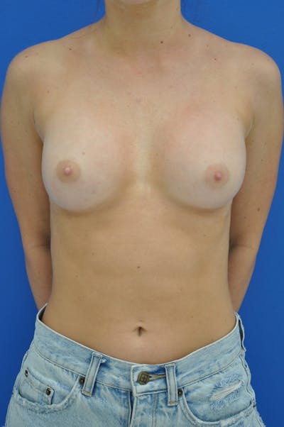 Breast Augmentation Before & After Gallery - Patient 146248616 - Image 2