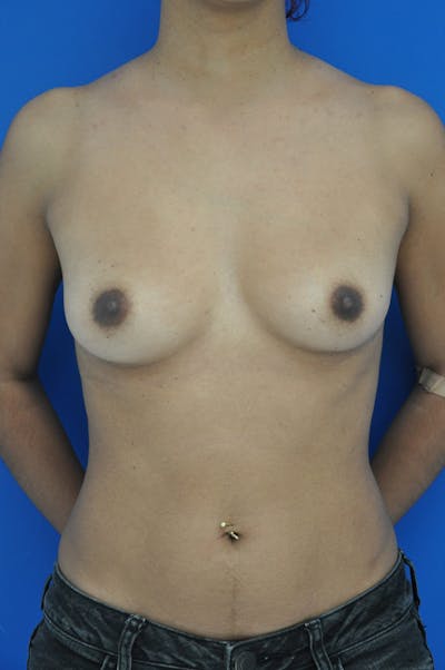Breast Augmentation Before & After Gallery - Patient 146248619 - Image 1
