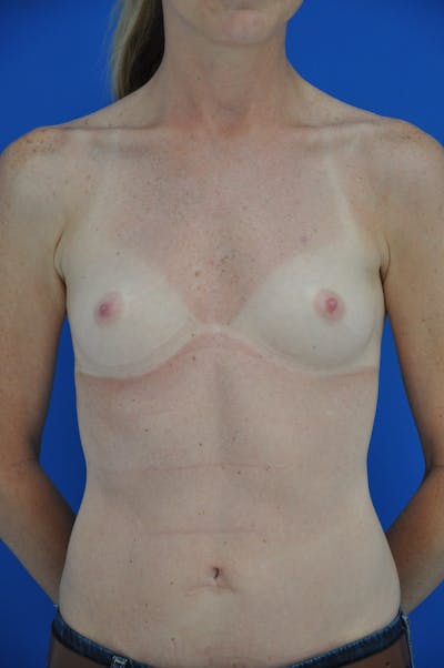 Breast Augmentation Before & After Gallery - Patient 146248833 - Image 1