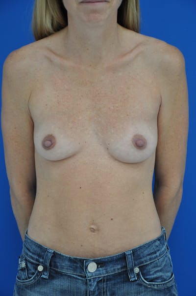 Breast Augmentation Before & After Gallery - Patient 146248835 - Image 1