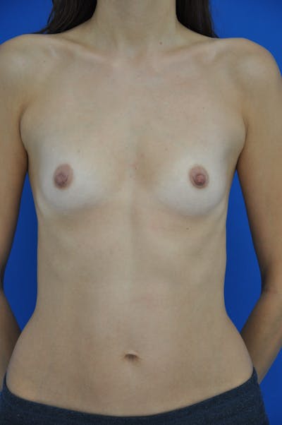 Breast Augmentation Before & After Gallery - Patient 146248840 - Image 1