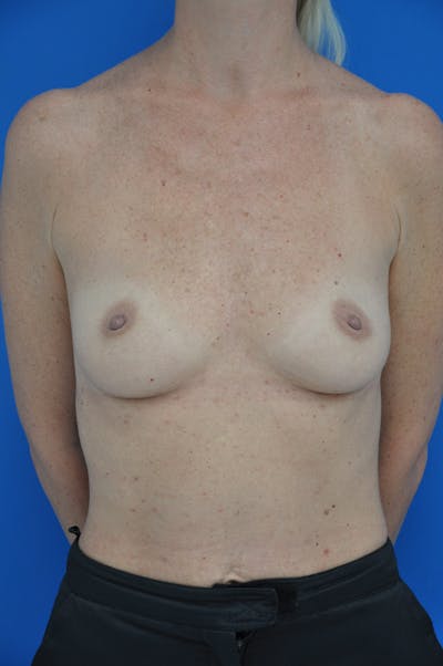 Breast Augmentation Before & After Gallery - Patient 146248841 - Image 1