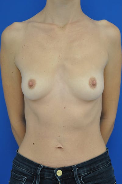 Breast Augmentation Before & After Gallery - Patient 146248846 - Image 1