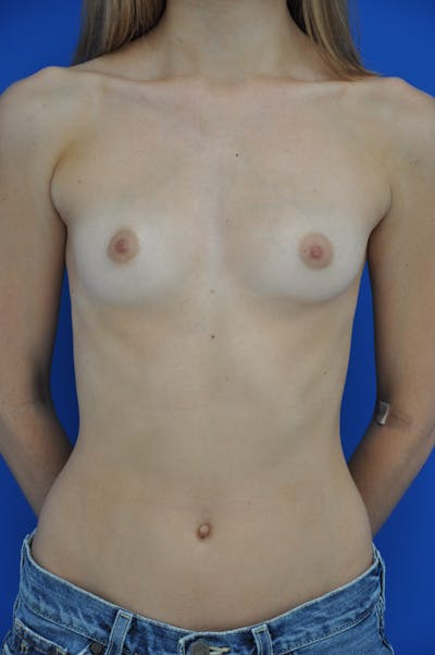 Breast Augmentation Before & After Gallery - Patient 146248855 - Image 1