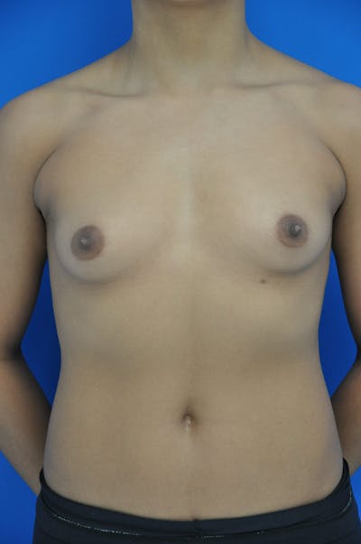 Breast Augmentation Before & After Gallery - Patient 146248856 - Image 1