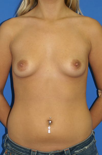 Breast Augmentation Before & After Gallery - Patient 146248857 - Image 1