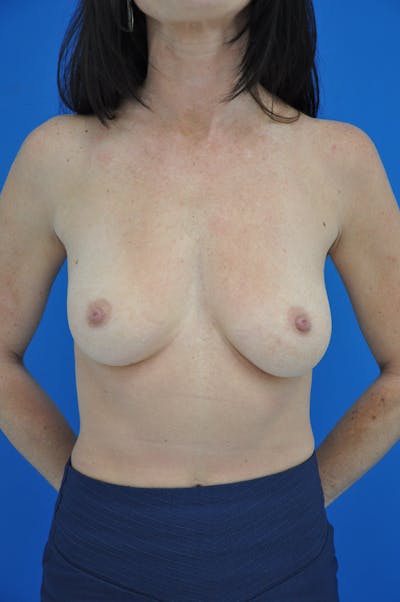 Breast Augmentation Before & After Gallery - Patient 146248860 - Image 1