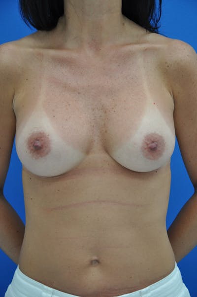 Breast Augmentation Before & After Gallery - Patient 146248862 - Image 2
