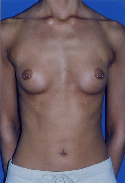 Breast Augmentation Before & After Gallery - Patient 146248875 - Image 1