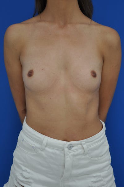 Breast Augmentation Before & After Gallery - Patient 146248880 - Image 1