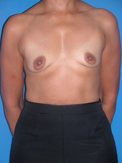 Breast Augmentation Before & After Gallery - Patient 146248882 - Image 1