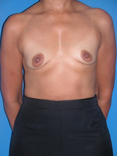 Breast Augmentation Before & After Gallery - Patient 146248882 - Image 1