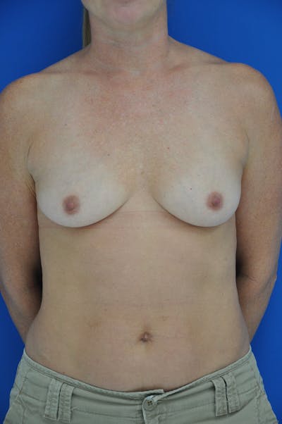 Breast Augmentation Before & After Gallery - Patient 146248921 - Image 1