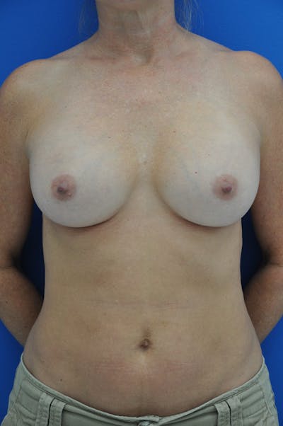 Breast Augmentation Before & After Gallery - Patient 146248921 - Image 2