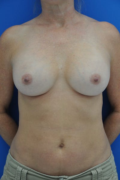 Breast Augmentation Before & After Gallery - Patient 146248921 - Image 2