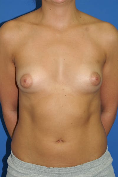 Breast Augmentation Before & After Gallery - Patient 146248922 - Image 1