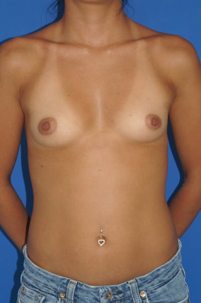Breast Augmentation Before & After Gallery - Patient 146248923 - Image 1