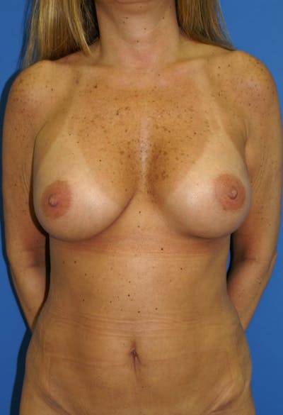 Breast Augmentation Before & After Gallery - Patient 146248924 - Image 2