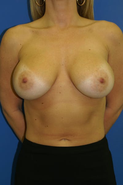 Breast Augmentation Before & After Gallery - Patient 146248928 - Image 2