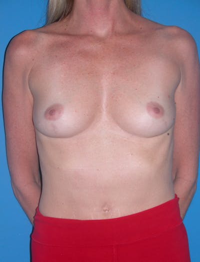 Breast Augmentation Before & After Gallery - Patient 146248933 - Image 1