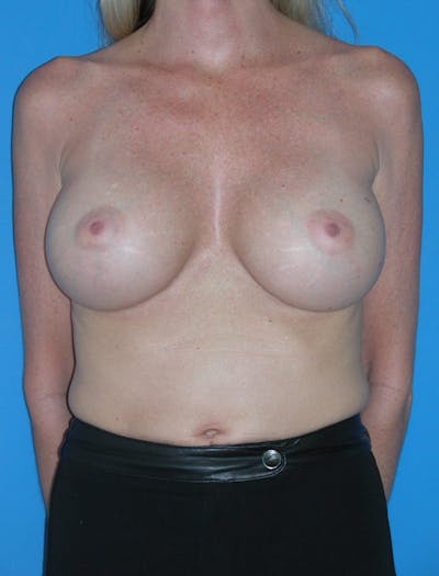 Breast Augmentation Before & After Gallery - Patient 146248933 - Image 2
