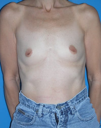 Breast Augmentation Before & After Gallery - Patient 146248954 - Image 1