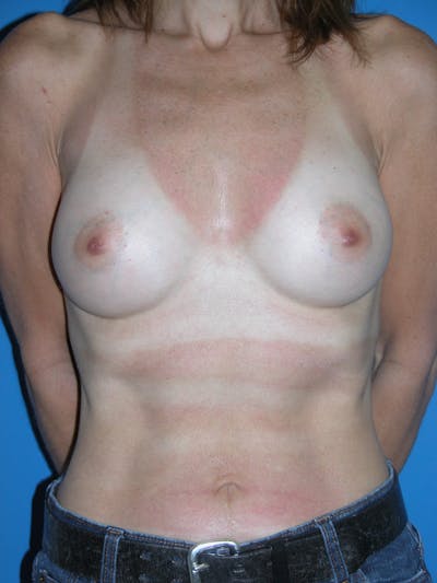 Breast Augmentation Before & After Gallery - Patient 146248954 - Image 2