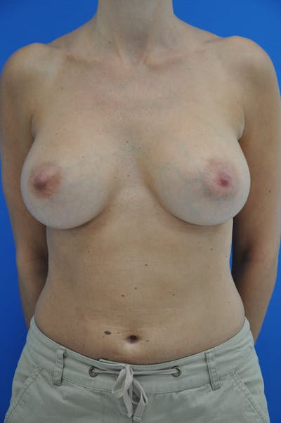 Breast Augmentation Before & After Gallery - Patient 146248957 - Image 2