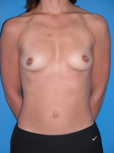 Breast Augmentation Before & After Gallery - Patient 146248963 - Image 1