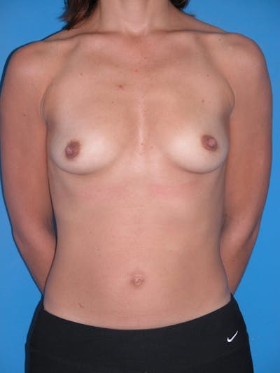 Breast Augmentation Before & After Gallery - Patient 146248963 - Image 1