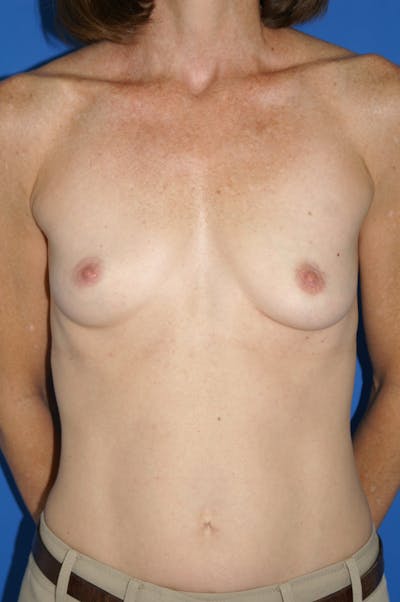 Breast Augmentation Before & After Gallery - Patient 146248964 - Image 1