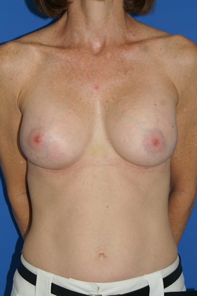 Breast Augmentation Before & After Gallery - Patient 146248964 - Image 2