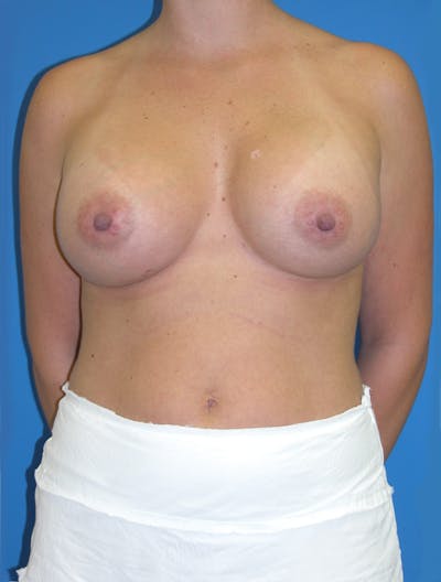 Breast Augmentation Before & After Gallery - Patient 146248967 - Image 2