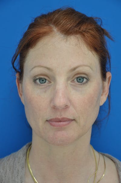 Facelift Before & After Gallery - Patient 148756398 - Image 1