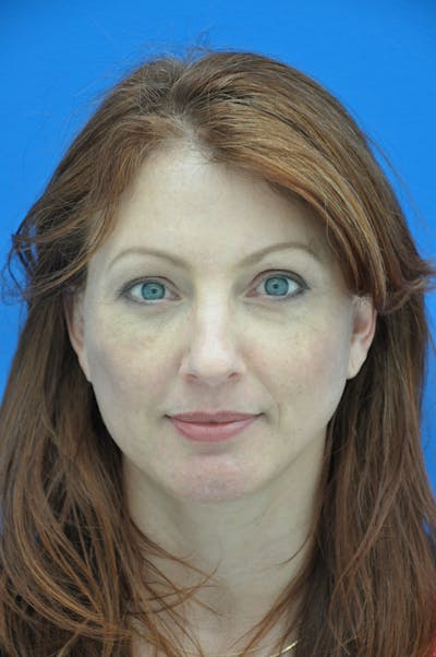 Facelift Before & After Gallery - Patient 148756398 - Image 2