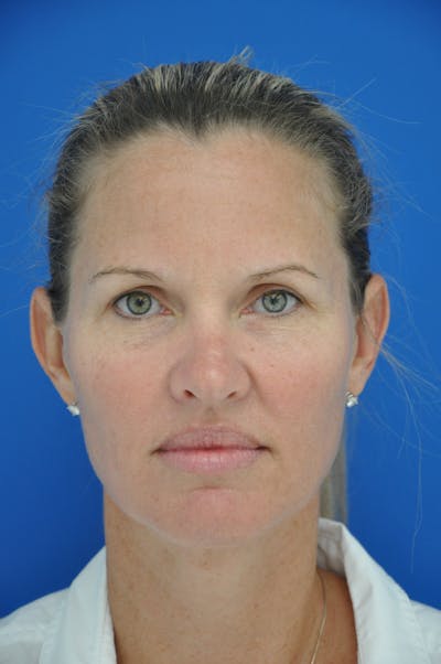 Facelift Before & After Gallery - Patient 148756411 - Image 1