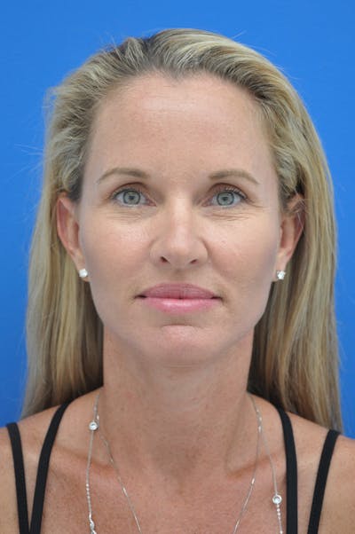Facelift Before & After Gallery - Patient 148756411 - Image 2